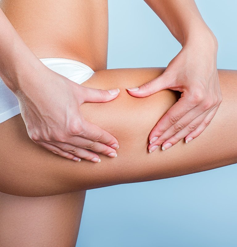 Eine Frau mit weißem Slip fasst sich an den Oberschenkel, um Cellulite zu zeigen